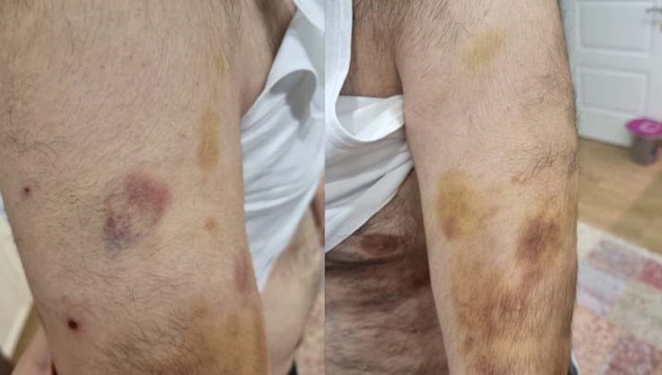 Eli ‘sopalı’ öğretmen! İstanbul’da otizmli öğrenciye şiddet