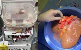 Organ naklinde yeni bir dönem… Cerrahlara zaman kazandırıyor