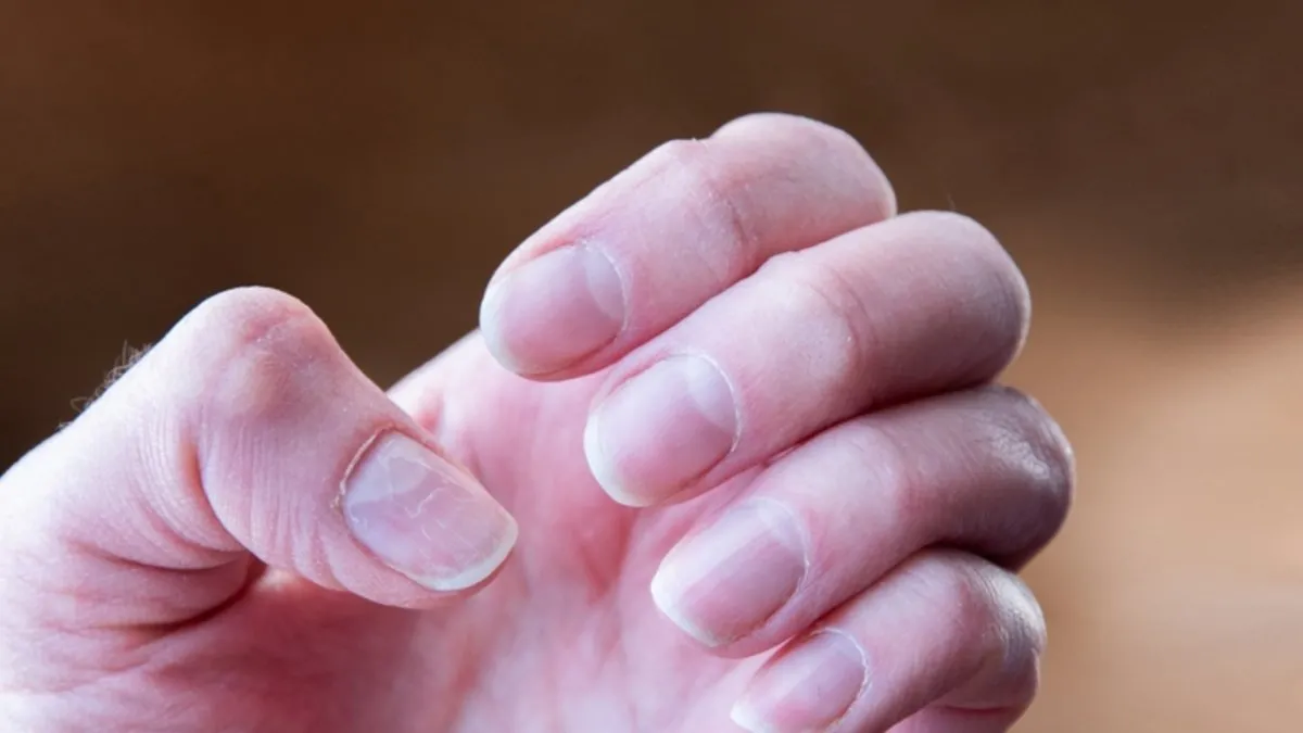 Bilim insanları açıkladı: Tırnaklardaki bu değişim kanserin gizli işaretiymiş!
